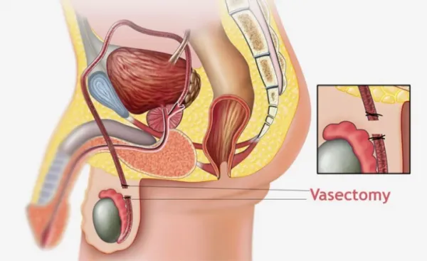  عکس و فیلم بستن لوله مردان
