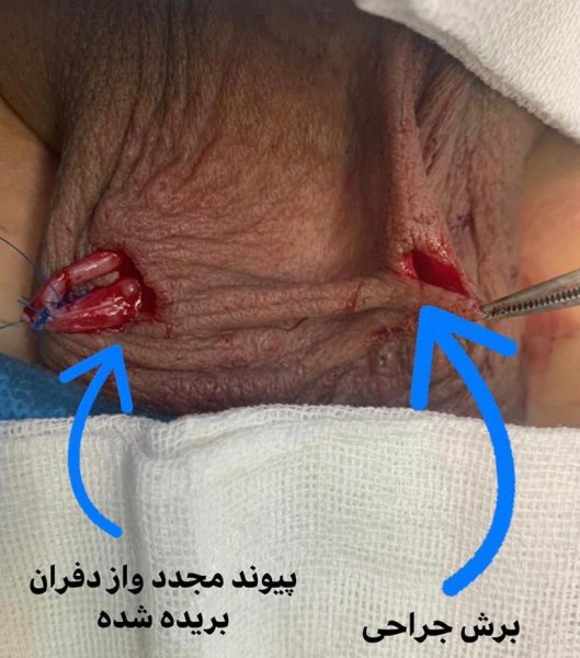  عکس و فیلم بستن لوله مردان