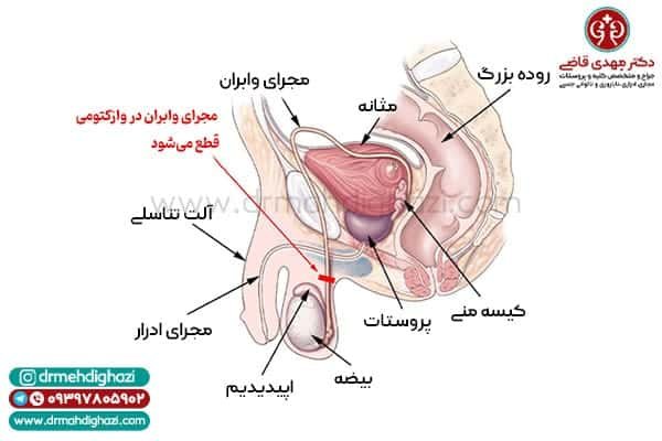  عکس و فیلم بستن لوله مردان