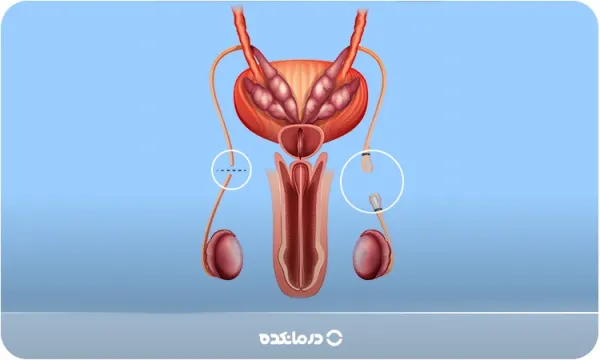 بستن لوله مردان موقت