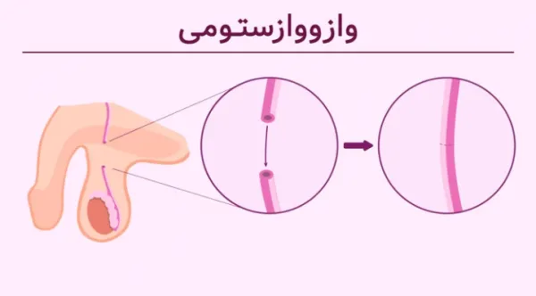  بستن لوله مردان موقت