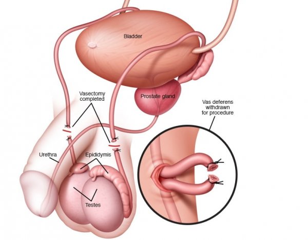  بستن لوله مردان موقت