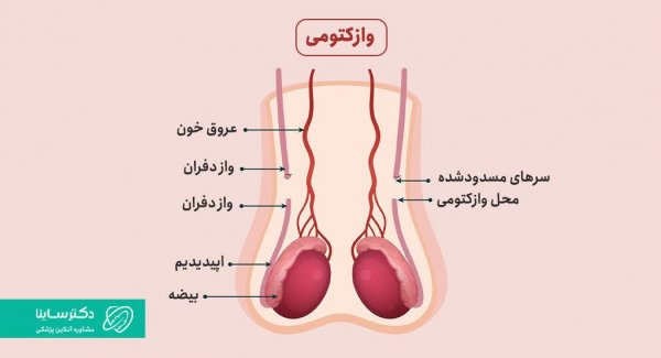  بستن لوله مردان موقت