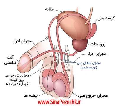  بستن لوله مردان موقت