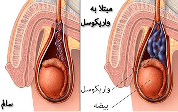 آیا هیدروسل باعث معافیت می شود؟