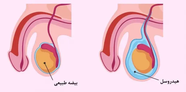  آیا هیدروسل باعث معافیت می شود؟