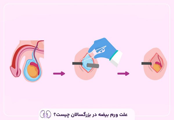  علت آب آوردن بیضه در بزرگسالان