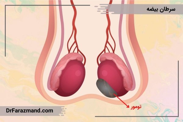 کیست بیضه بدخیم