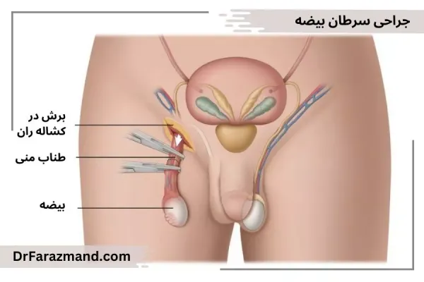  کیست بیضه بدخیم