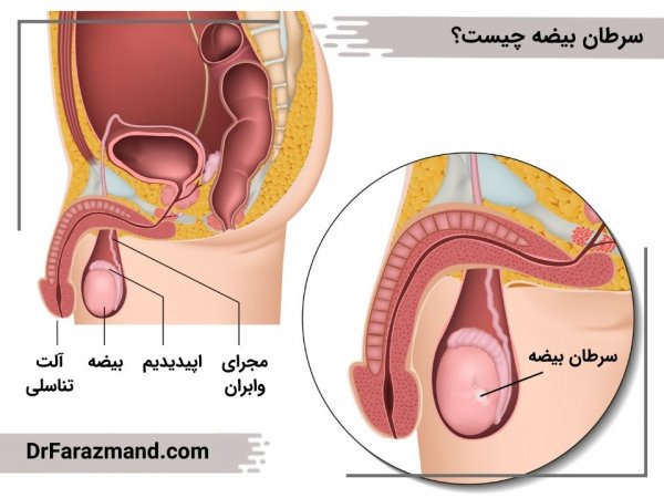  کیست بیضه بدخیم