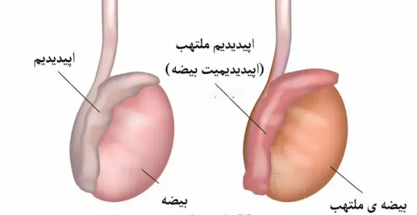  کیست بیضه بدخیم