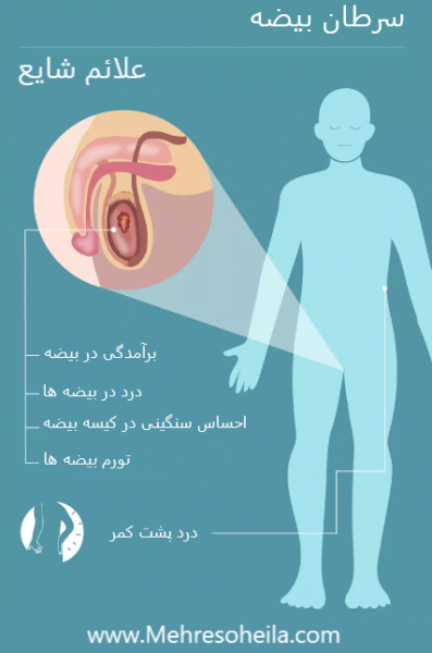  کیست بیضه بدخیم