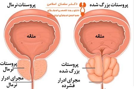  سرطان پروستات چه عوارضی دارد؟