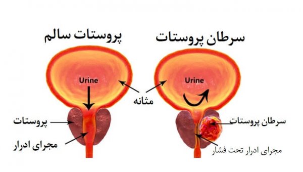  برای ورم پروستات چی بخوریم؟