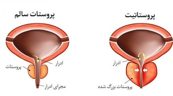  برای ورم پروستات چی بخوریم؟