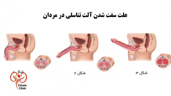  جوانسازی آلت تناسلی مردان
