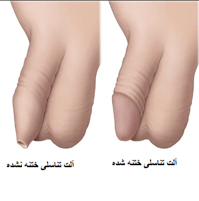  جوانسازی آلت تناسلی مردان