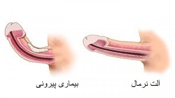  جوانسازی آلت تناسلی مردان