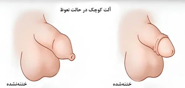  جوانسازی آلت تناسلی مردان