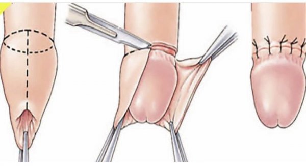  تزیین ناحیه تناسلی مردان و زنان