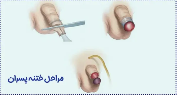  عکس زیاد بریدن پوست در ختنه