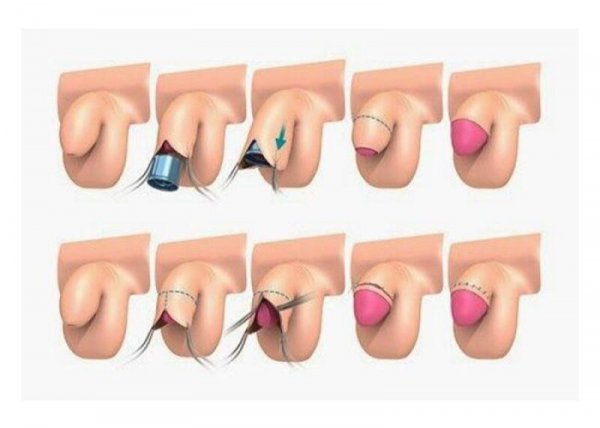  عکس زیاد بریدن پوست در ختنه