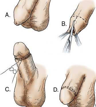  عکس زیاد بریدن پوست در ختنه