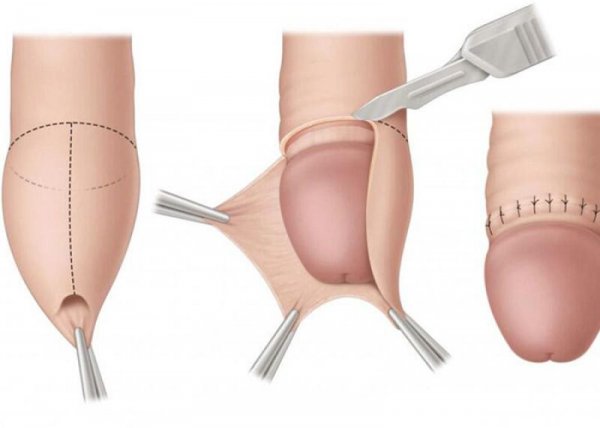  عکس زیاد بریدن پوست در ختنه