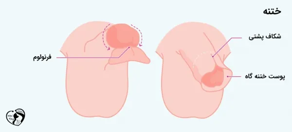  عوارض بد ختنه شدن و زود انزالی