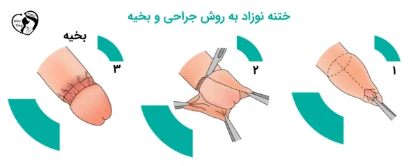  عوارض بد ختنه شدن و زود انزالی
