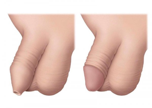  عوارض ختنه زود هنگام