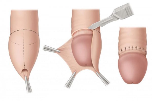  عوارض ختنه زود هنگام