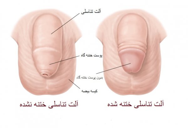 عوارض ختنه زود هنگام