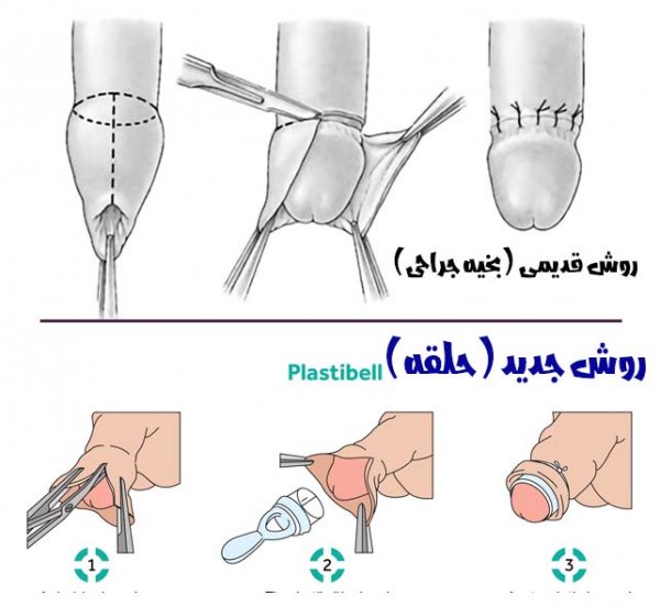  عکس ختنه نادرست نوزاد