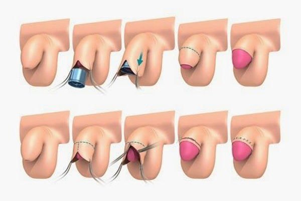  ناحیه ختنه گاه مرد کجاست + عکس ختنه گاه