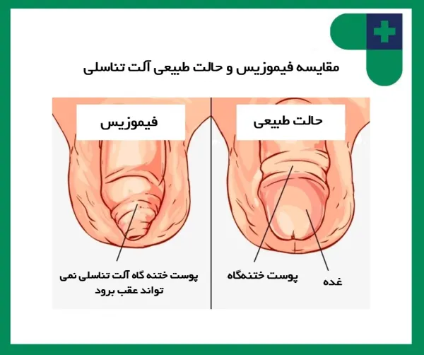  ناحیه ختنه گاه مرد کجاست + عکس ختنه گاه