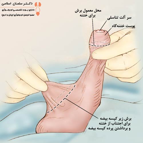  ناحیه ختنه گاه مرد کجاست + عکس ختنه گاه