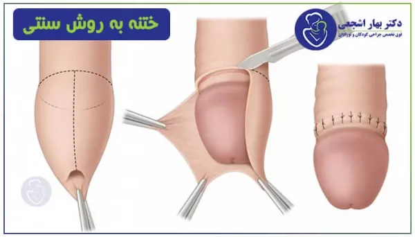  ناحیه ختنه گاه مرد کجاست + عکس ختنه گاه