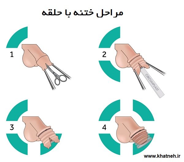  ناحیه ختنه گاه مرد کجاست + عکس ختنه گاه