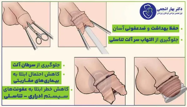  عکس ختنه به روش حلقه + عکس ختنه به روش سنتی