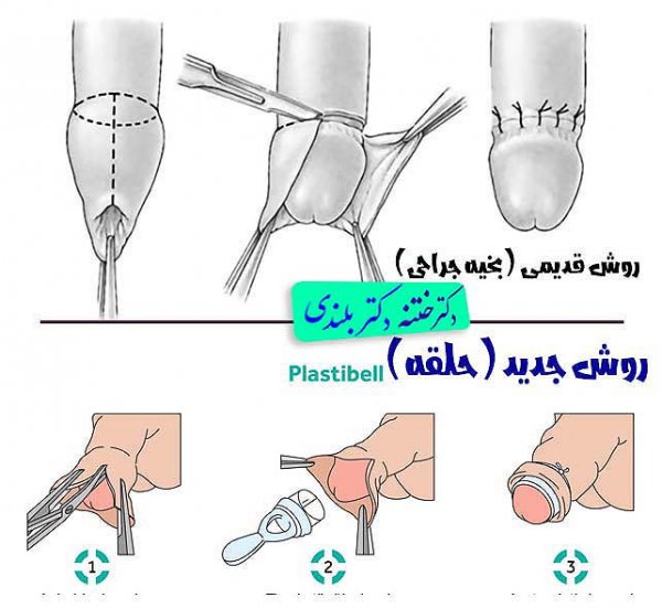  عکس ختنه به روش حلقه + عکس ختنه به روش سنتی