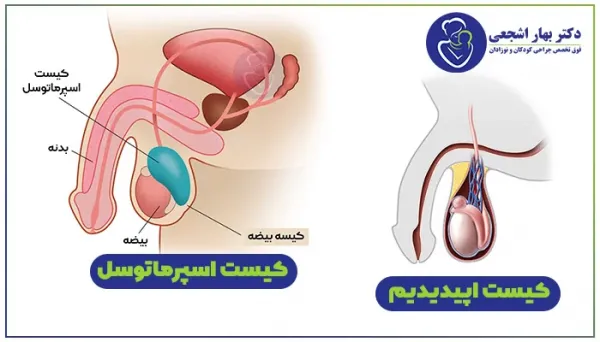  کیست مویی پایین بیضه