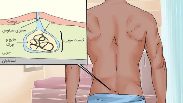  کیست مویی پایین بیضه