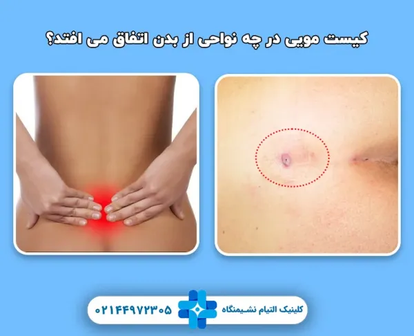  کیست مویی پایین بیضه