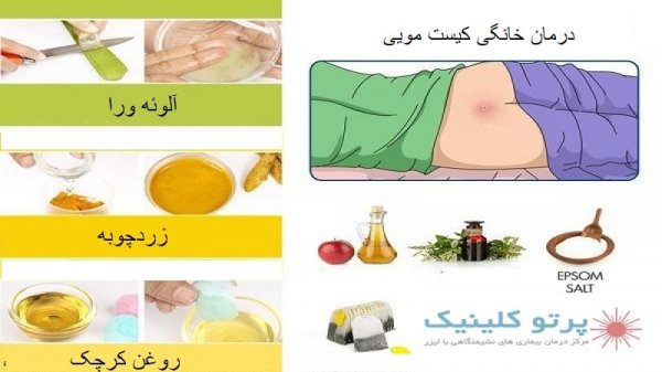  کیست مویی پایین بیضه