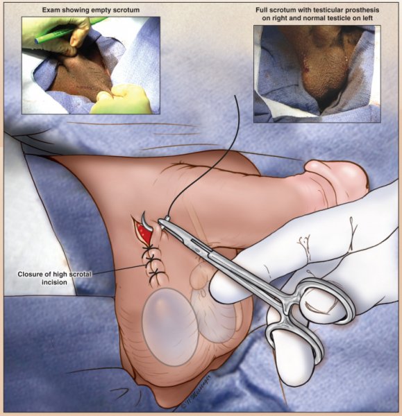  عکس پروتز بیضه + انواع پروتز بیضه