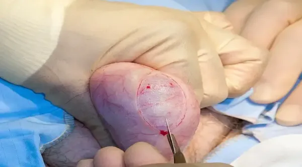 عکس کیست اپیدیدیم