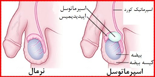  عکس کیست اپیدیدیم