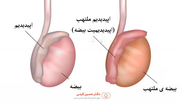  عکس کیست اپیدیدیم