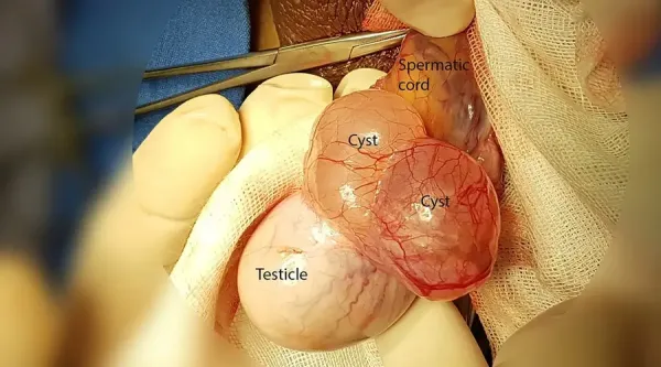  عکس کیست اپیدیدیم